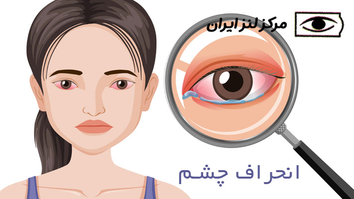 راه‌های پیشگیری از انحراف چشم در کودکان